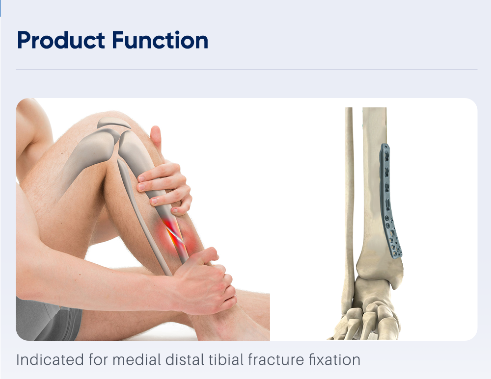 Medial Polyaxial Plate for Distal Tibia - Buy Product on XC Medico Medial Polyaxial Plate for Distal Tibia - Buy Product on XC Medico