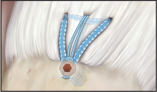 Suture tape in rotator cuff repair Suture tape in rotator cuff repair