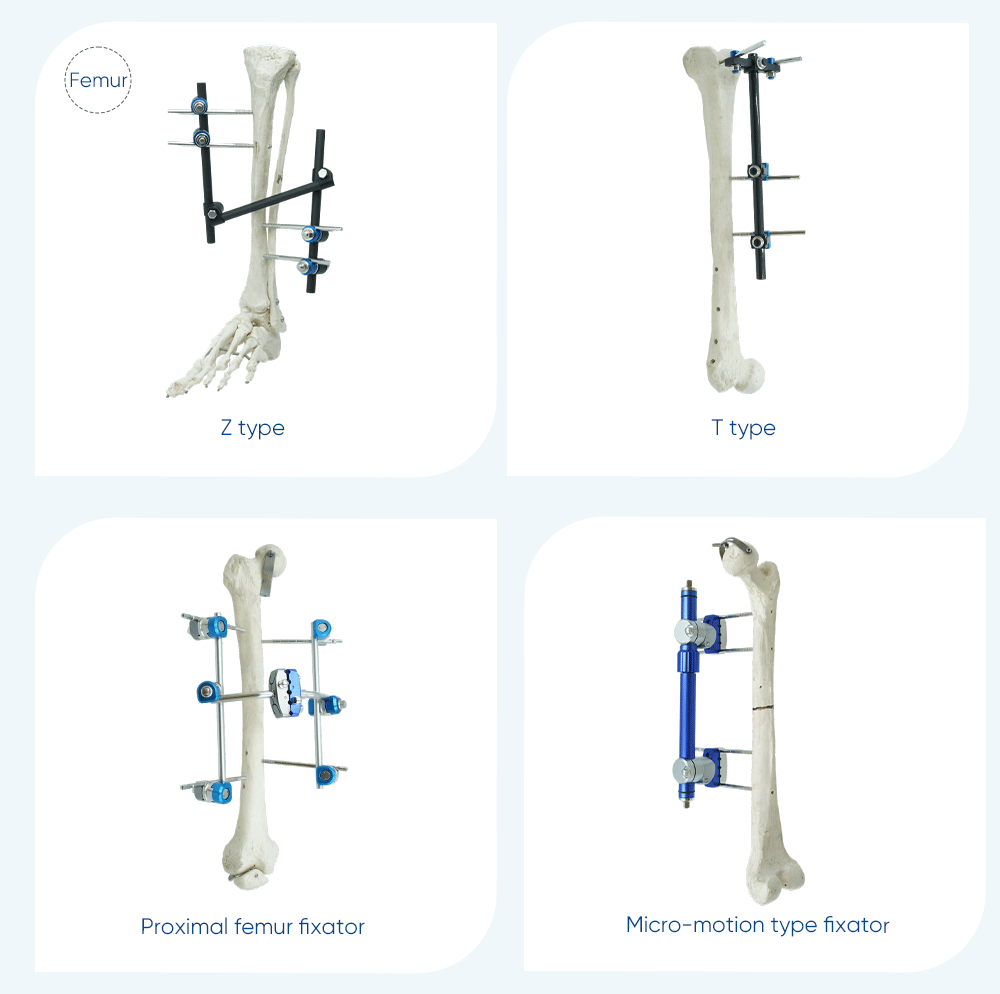 External Fixator for Leg - Buy Product on XC Medico  External Fixator for Leg - Buy Product on XC Medico
