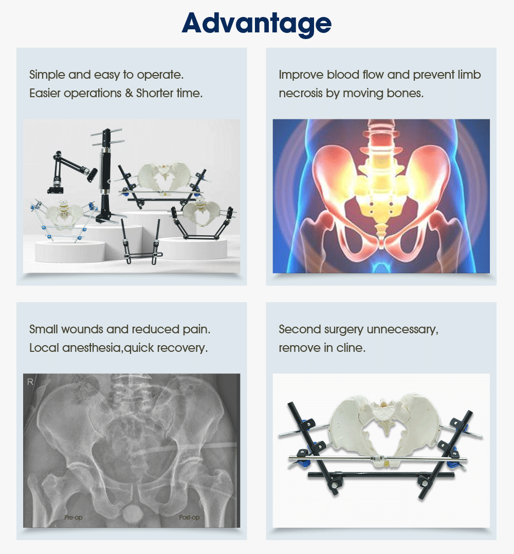 Pelvic & Ankle Fixator External - Buy Product on XC Medico Pelvic & Ankle Fixator External - Buy Product on XC Medico