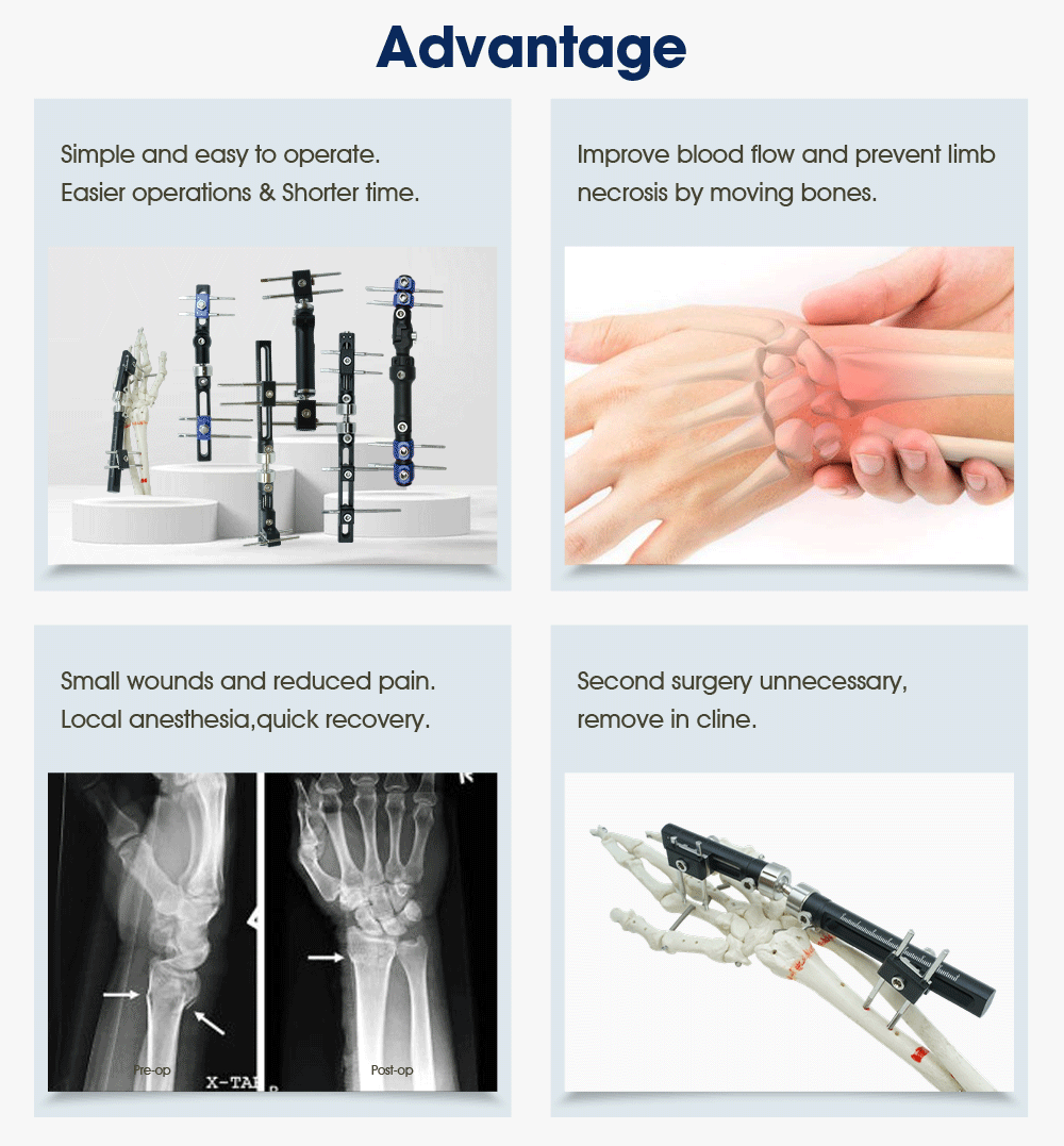 Wrist External Fixator - Buy Product on XC Medico Wrist External Fixator - Buy Product on XC Medico