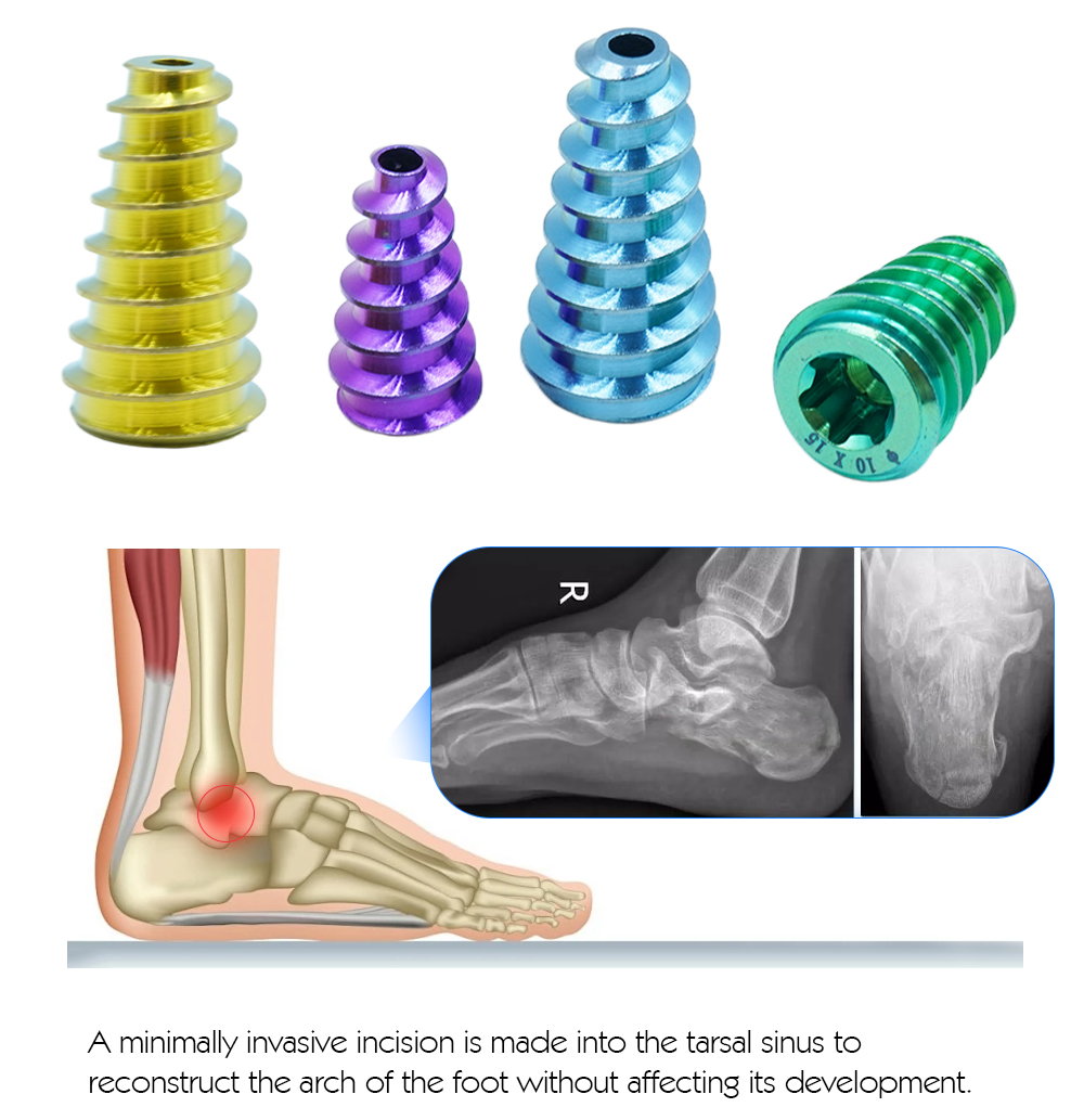 ACL Interference Screws in Surgery