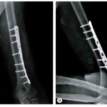 How Orthopaedic Implants Work How Orthopaedic Implants Work