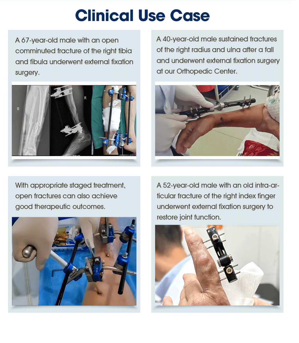 External Fixator for Leg - Buy Product on XC Medico  External Fixator for Leg - Buy Product on XC Medico