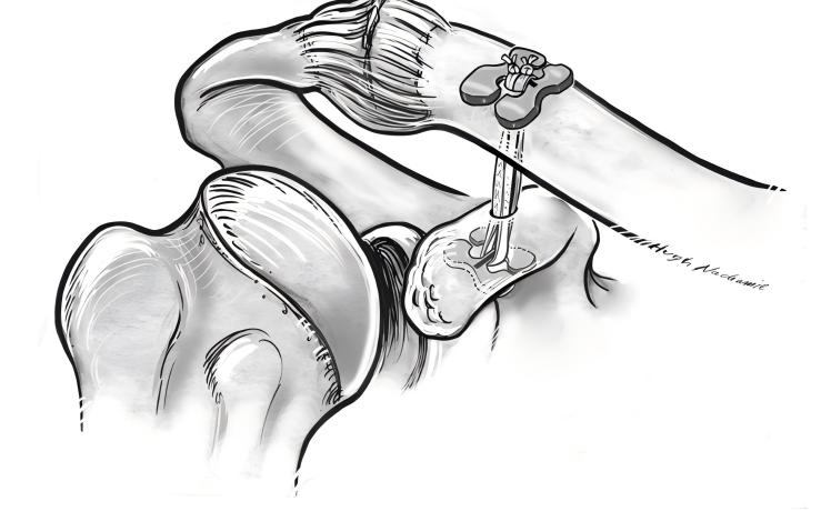 Titanium plate repair Titanium plate repair