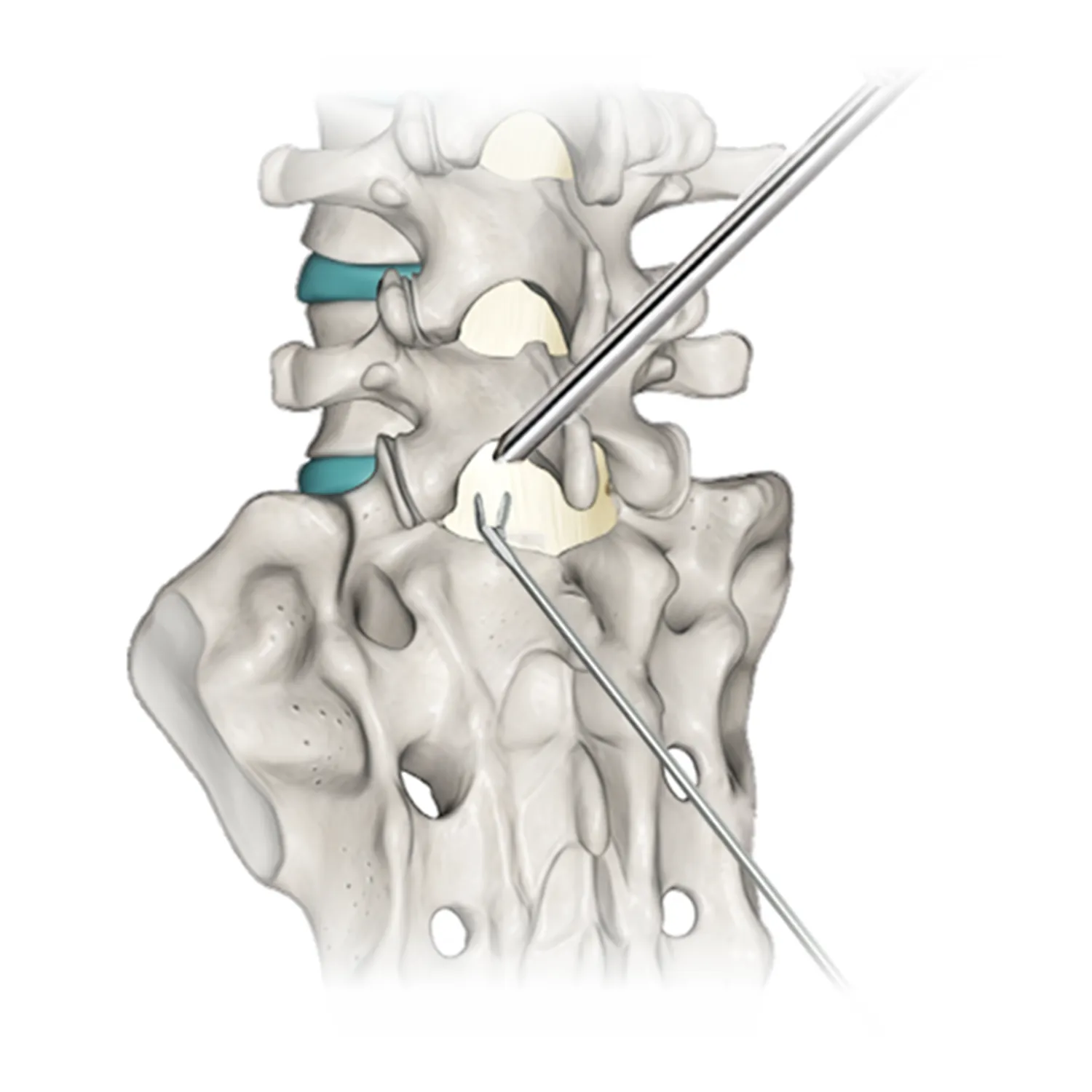 Orthopedic Spinal Implants Types Materials and Manufacturing Trends Orthopedic Spinal Implants Types Materials and Manufacturing Trends