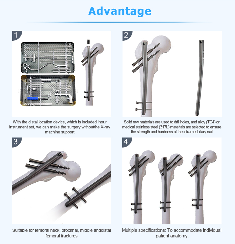 Titanium Gamma Nail | Proximal Femoral Fracture Fixation Implants - XC Medico - 3 Titanium Gamma Nail | Proksimaaliset reisiluun murtuman kiinnitysimplantit - XC Medico - 3