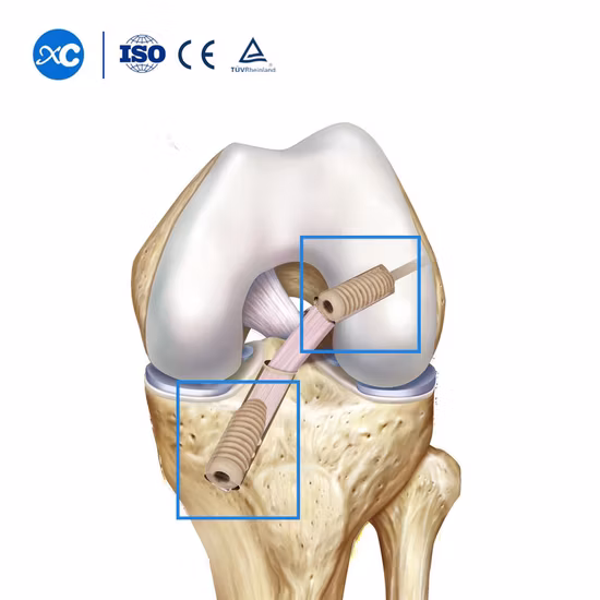 PEEK Suture Anchor Screw (ACL/PCL)