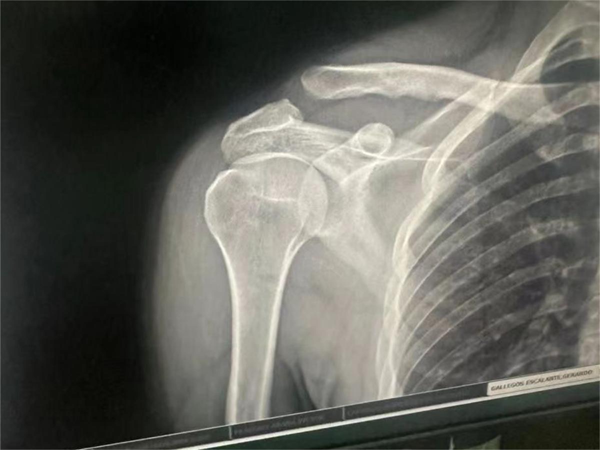 What situations require trauma implants?