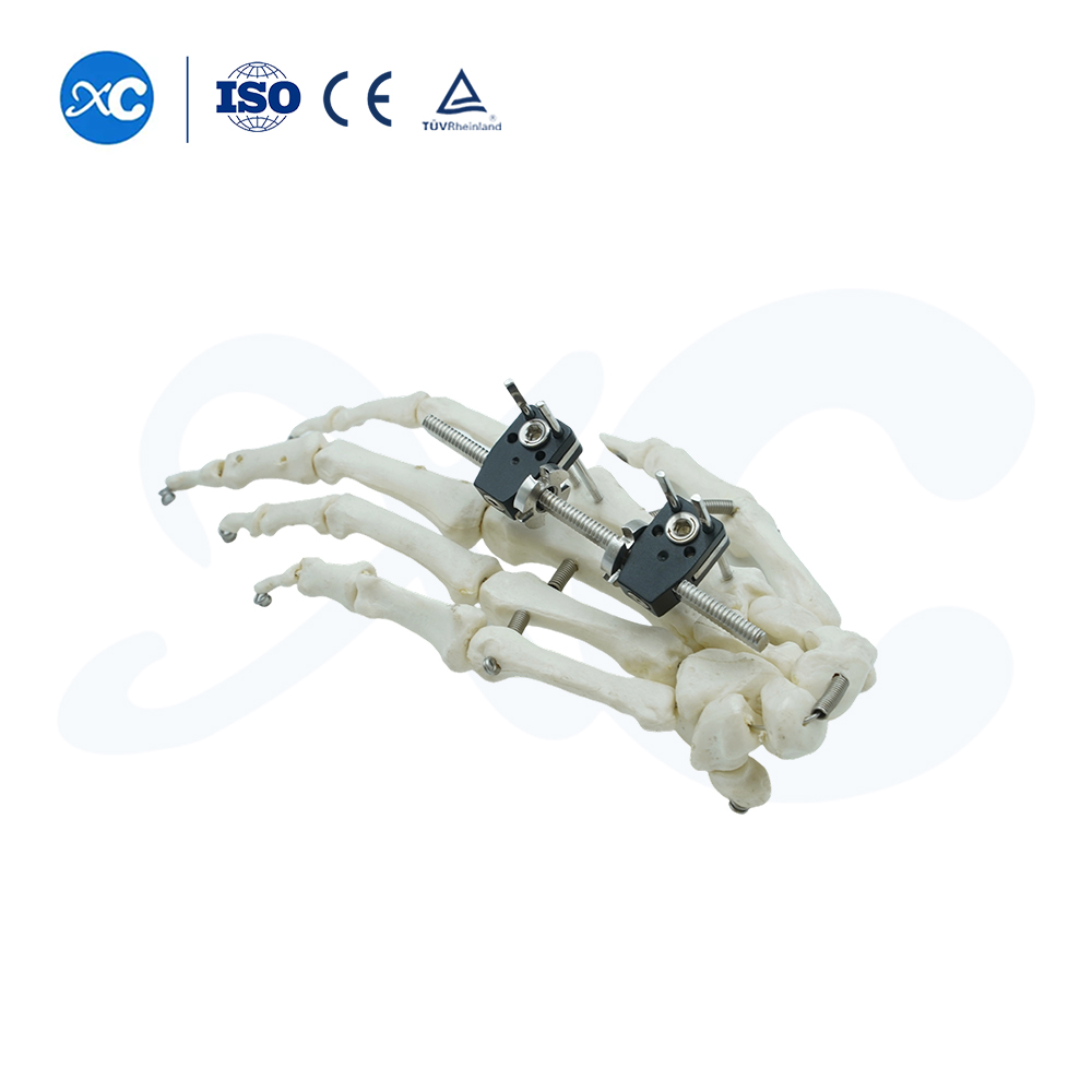 External Fixation for Metacarpals And Phalanges - Buy Product on XC Medico