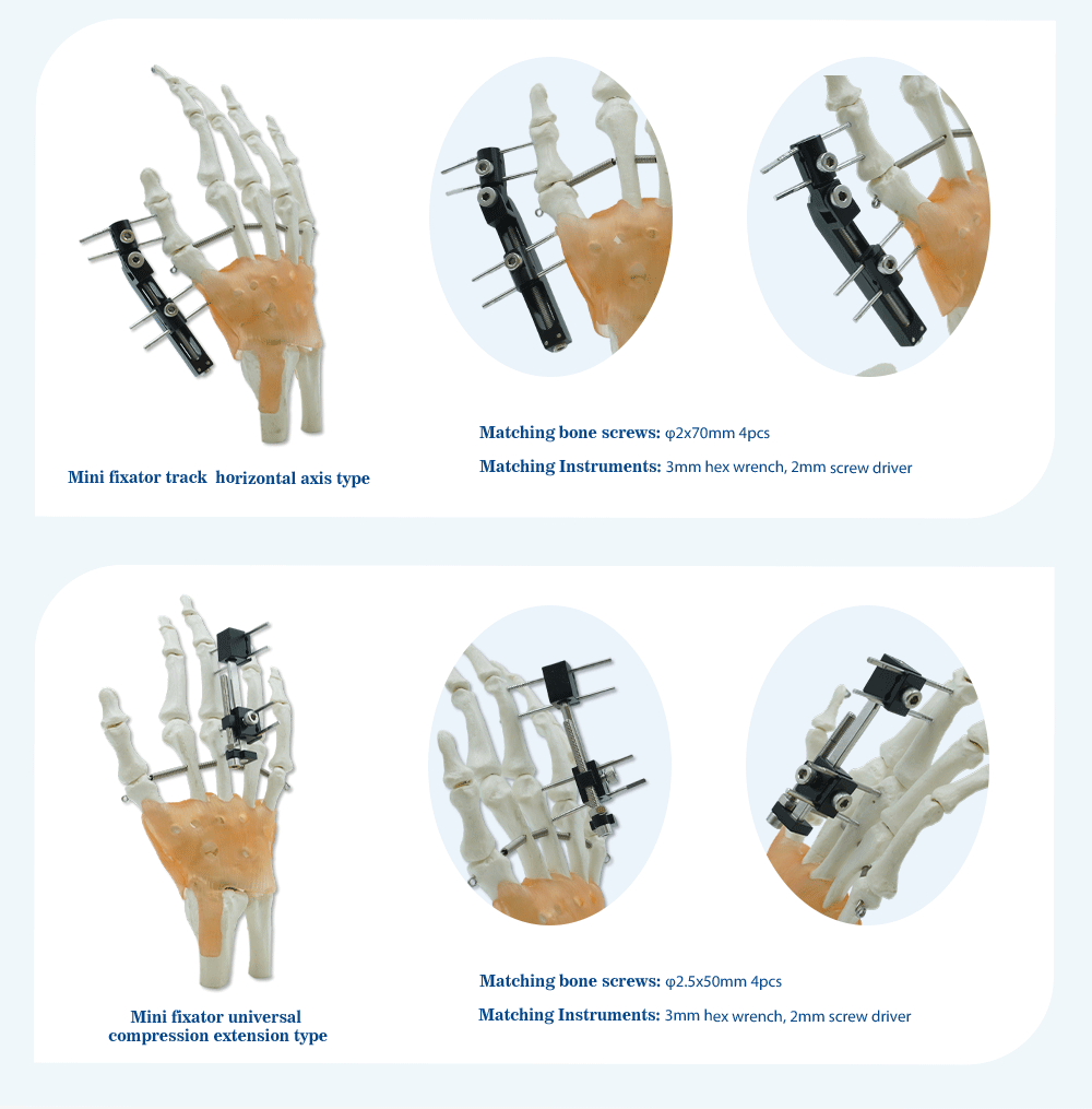 External Fixation Of Metacarpals And Phalanges - Image 4