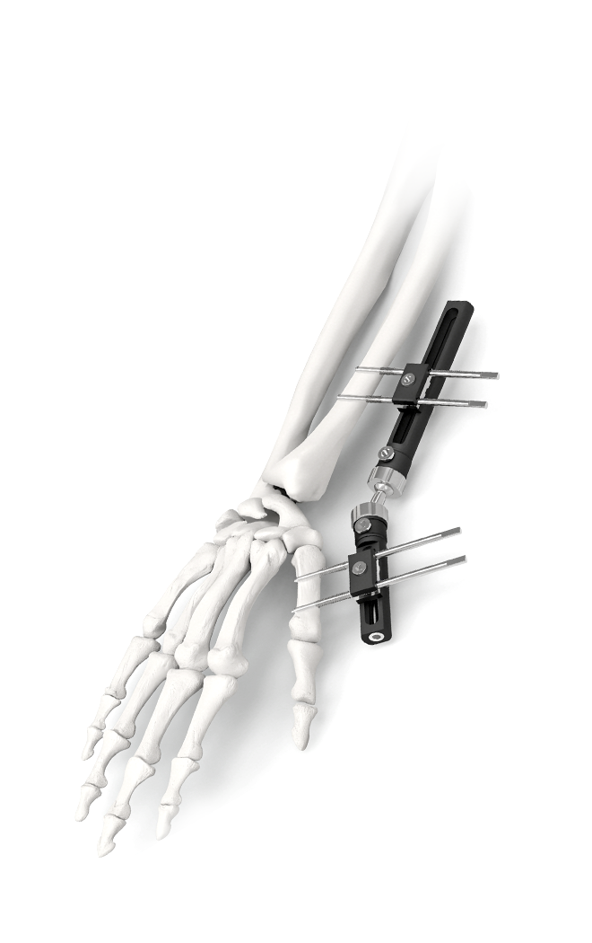 External Fixators System