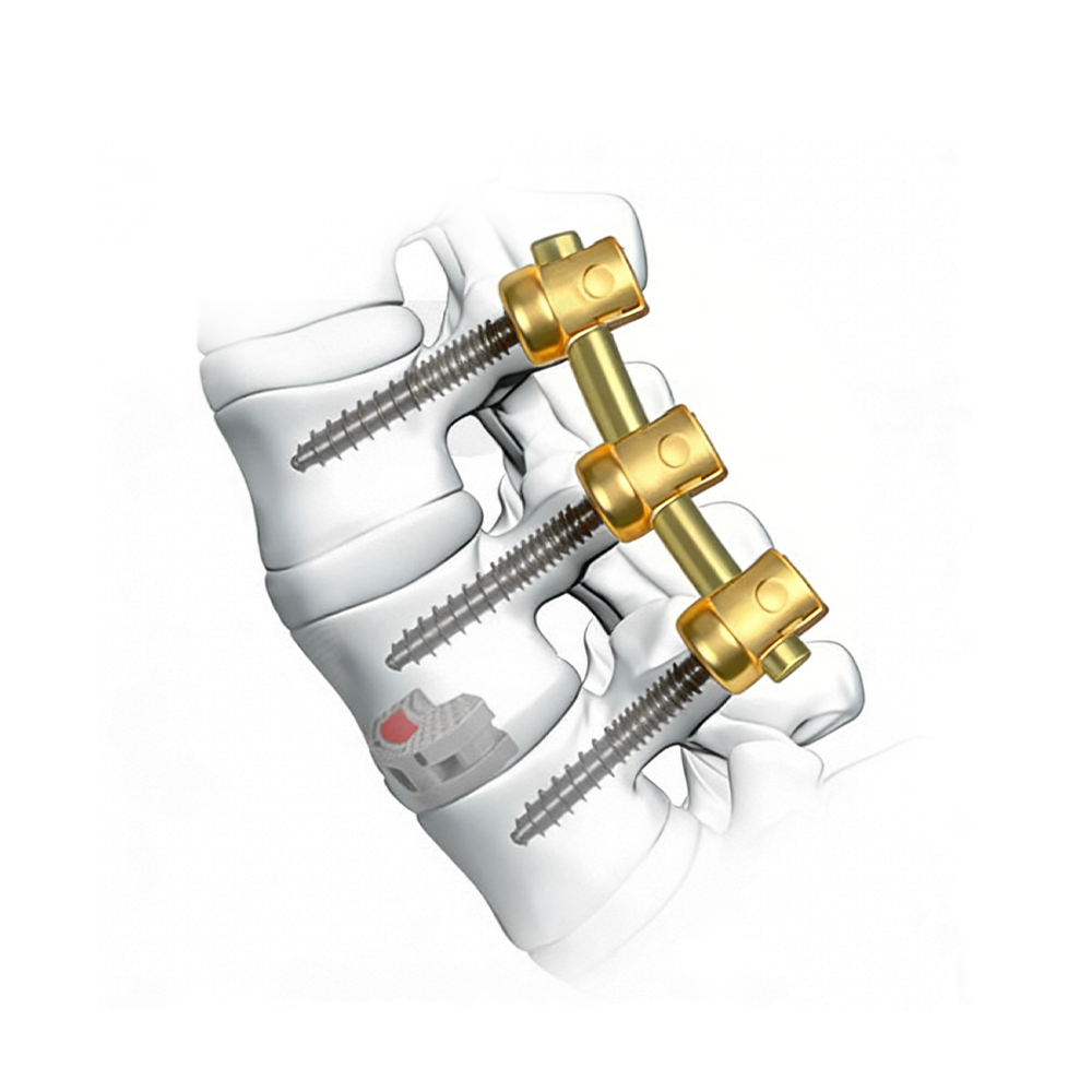 Spinal pedicle screw systems