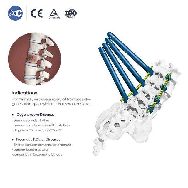 MisFix 5.5 System | Minimally Invasive Pedicle Screw | XC Medico