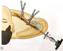 Dijanjosi u Trattament ta 'Frattura ta' Clavicle-20