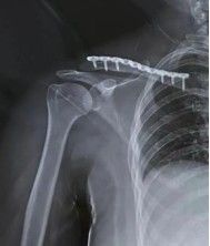 Dijanjosi u Trattament ta 'Frattura ta' Clavicle-24
