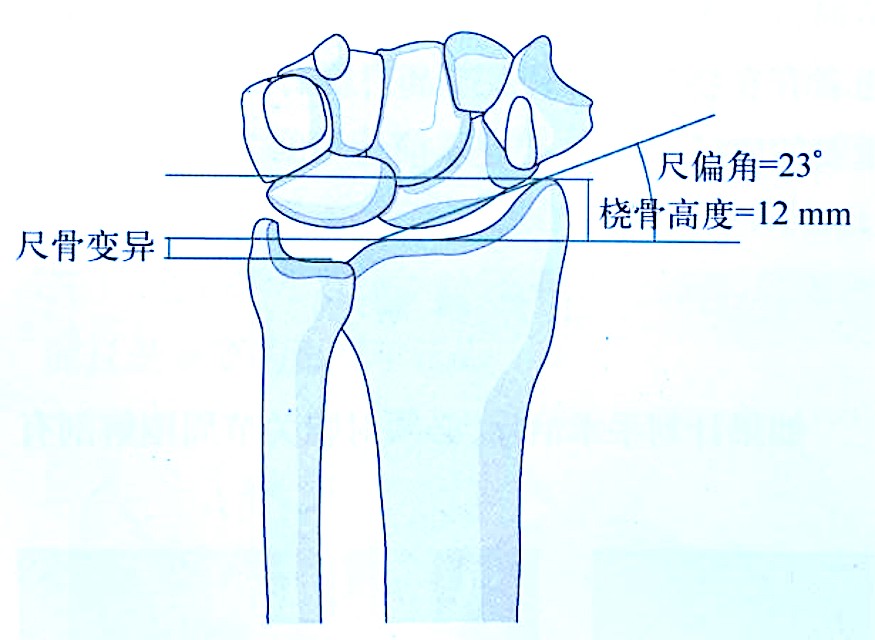 Distal Radius Fractures-1