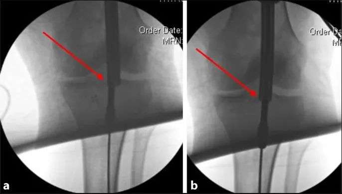 ការបាក់ឆ្អឹង Tibial, strapatellar intripatorlary បច្ចេកទេសក្រចក -23