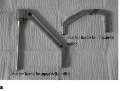 ការបាក់ឆ្អឹង Tibial, Suprapatellar Litrimallary Tearique-16