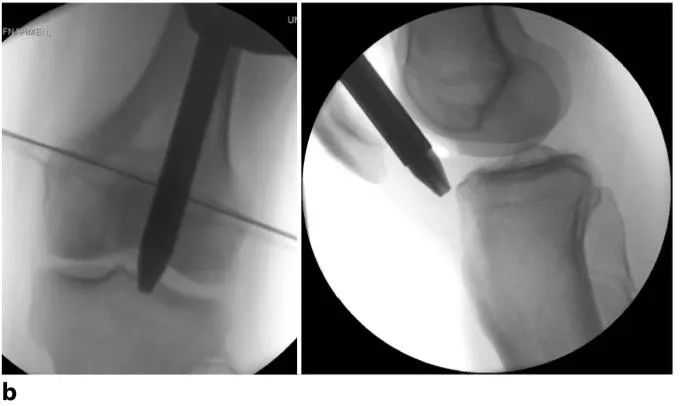ការបាក់ឆ្អឹង Tibial, strapatellar intripatlumnlyullary បច្ចេកទេសក្រចក -8