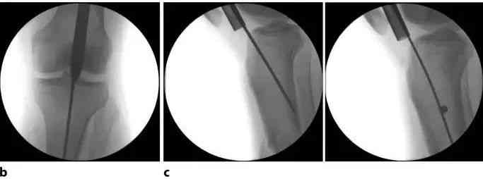 ការបាក់ឆ្អឹង Tibial, Suprapatellar Litrimullary Tearique-11