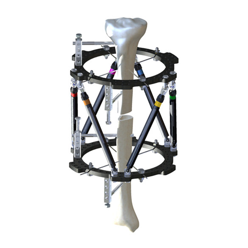 external-fixation