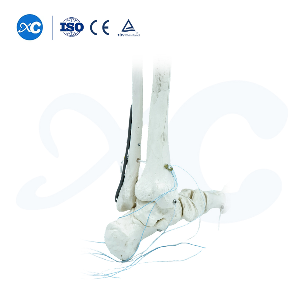 Distal Tibiofibular Locking Plate-III - Buy Product on XC Medico