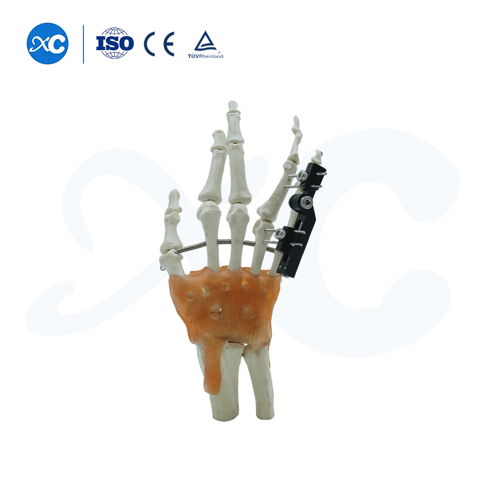 External Fixation for Metacarpals And Phalanges - Buy Product on XC Medico