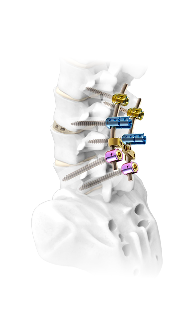 how long does a spinal cage last