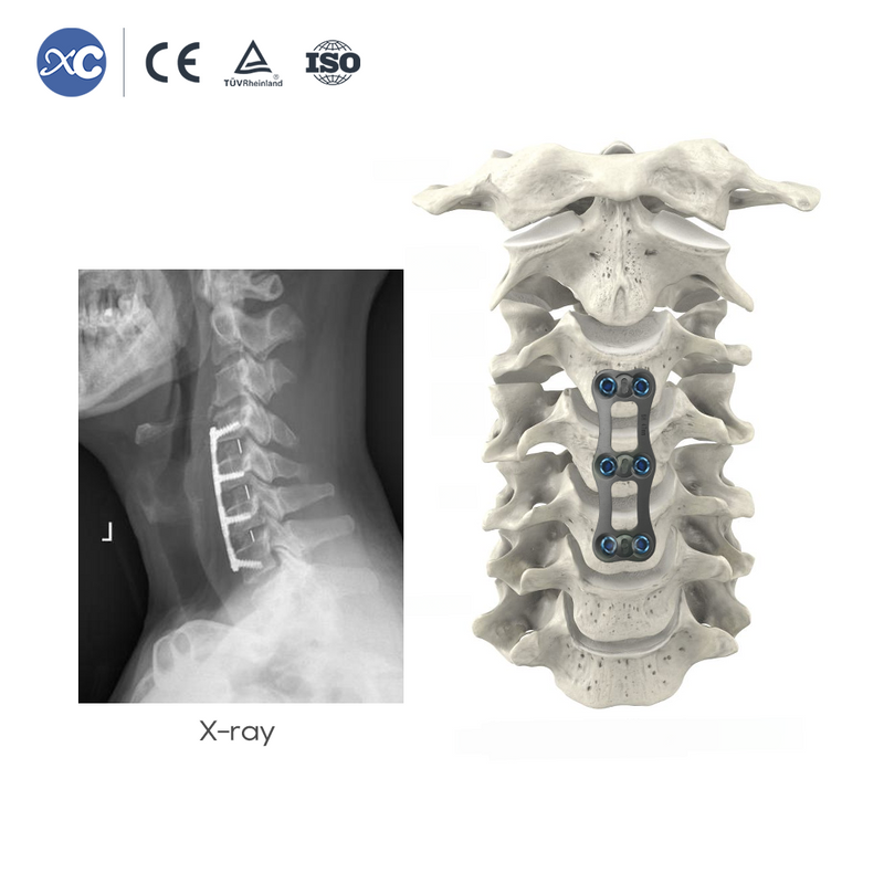 Anterior Cervical Plate System | Titanium Spine Implant | XC Medico
