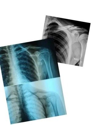 Dijanjosi u Trattament ta 'Frattura ta' Clavicle-4