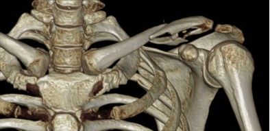 Dijanjosi u Trattament ta 'Frattura ta' Clavicle-9