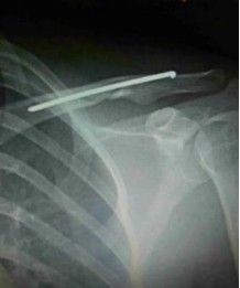 Dijanjosi u Trattament ta 'Frattura ta' Clavicle-22