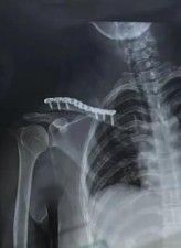 Dijanjosi u Trattament ta 'Frattura ta' Clavicle-25