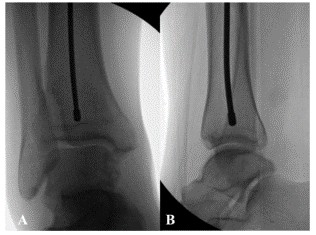 បច្ចេកទេសជួសជុលក្រចក Tibial Tibial Tienmation-Technique-10