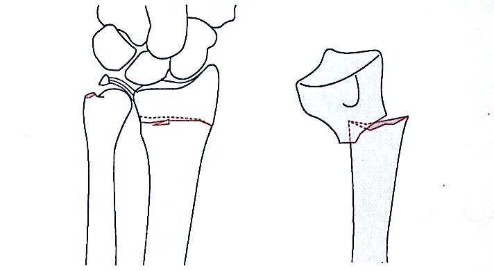 Distal Radius Fractures-3