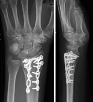 Distal Radius Fractures-13