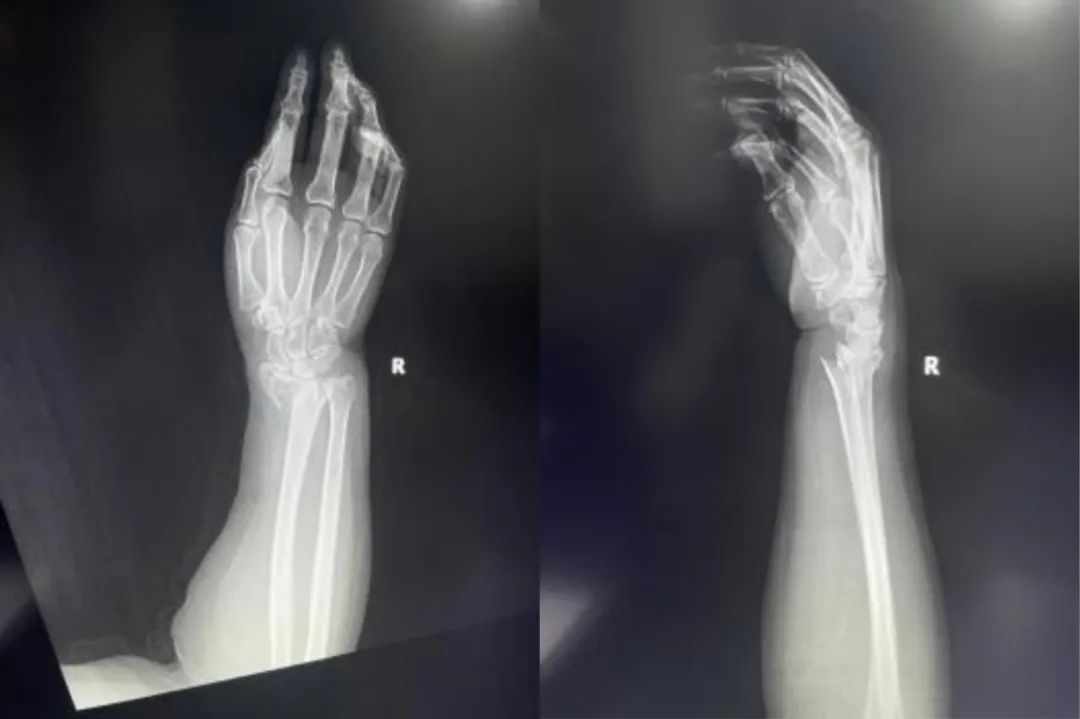 Distal Radius Fractures-19