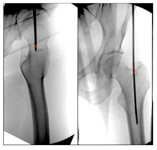 Femoral Intramedullary Nailing - How To Choose The Best Insertion Point-4