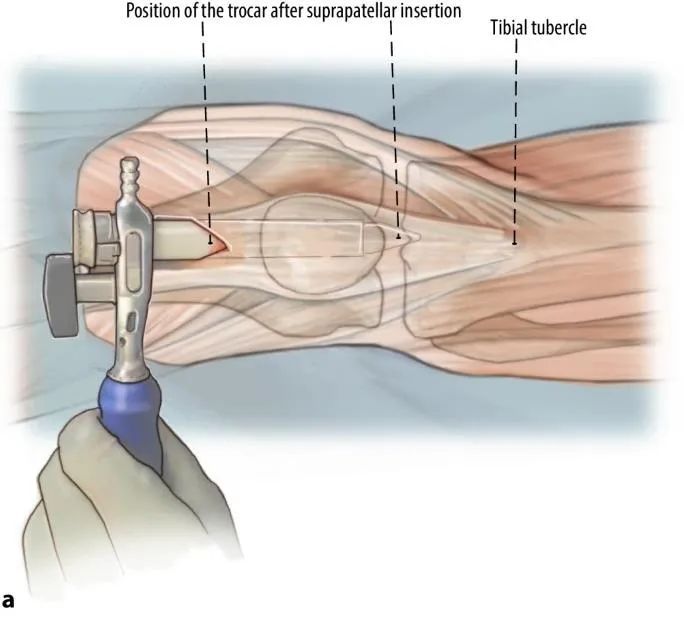 ការបាក់ឆ្អឹង Tibial, Suprapatellar Litrimalullary Teail-7