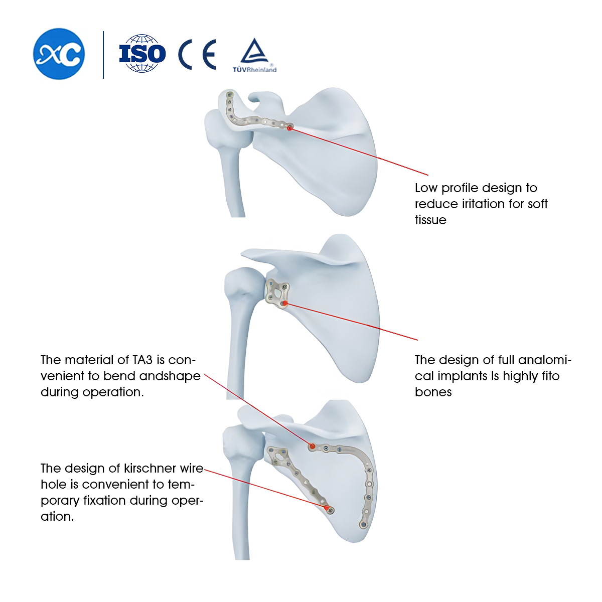 Plat mengunci scapula