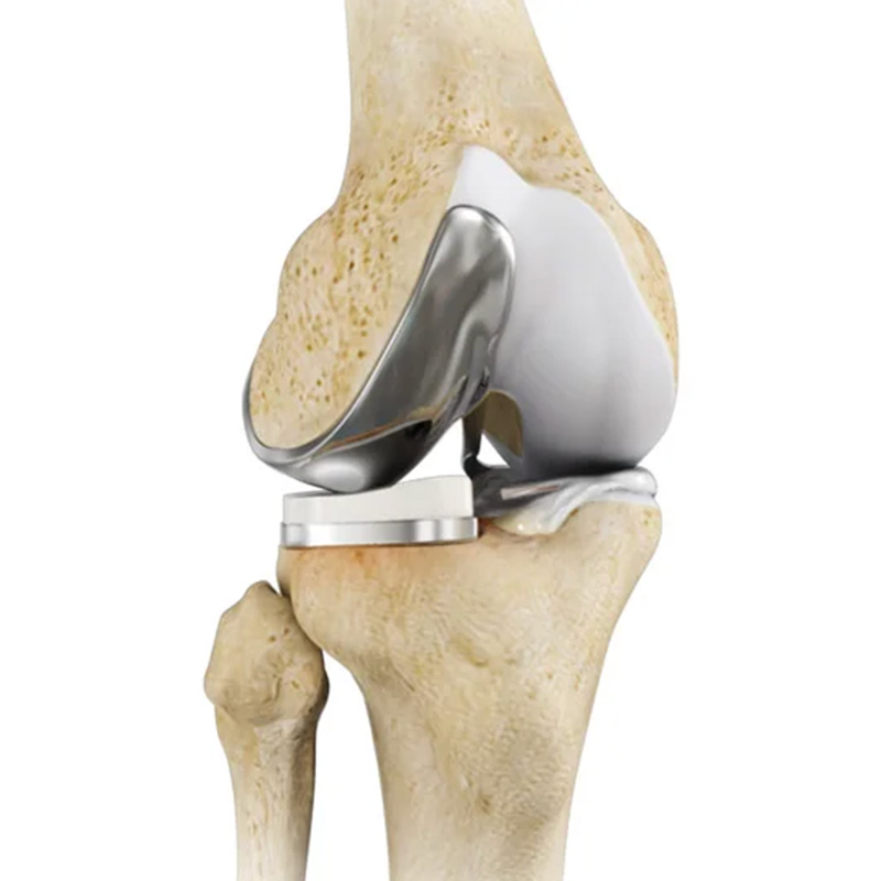 knee-joint-prosthesis-