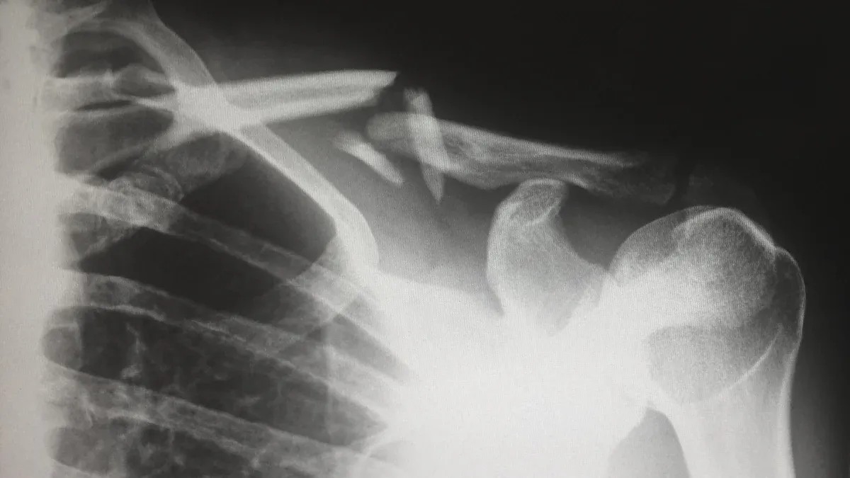 AC joint dislocation and how Titanium Plate makes a difference