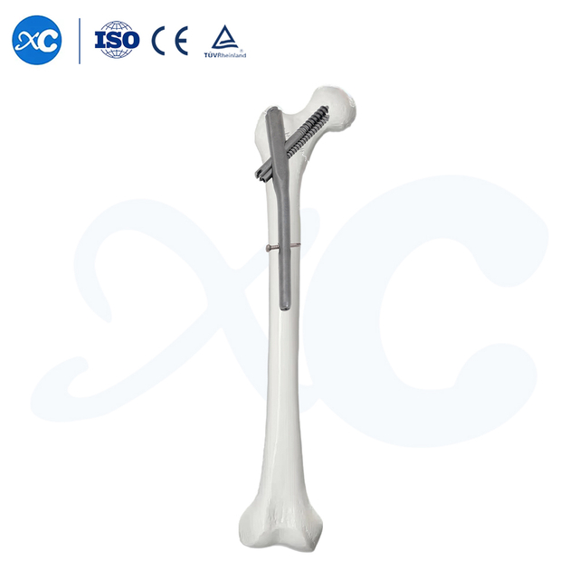 Intertan Nail System | Anti-Rotation Femoral Interlocking Nail | Eliminates Z-Effect