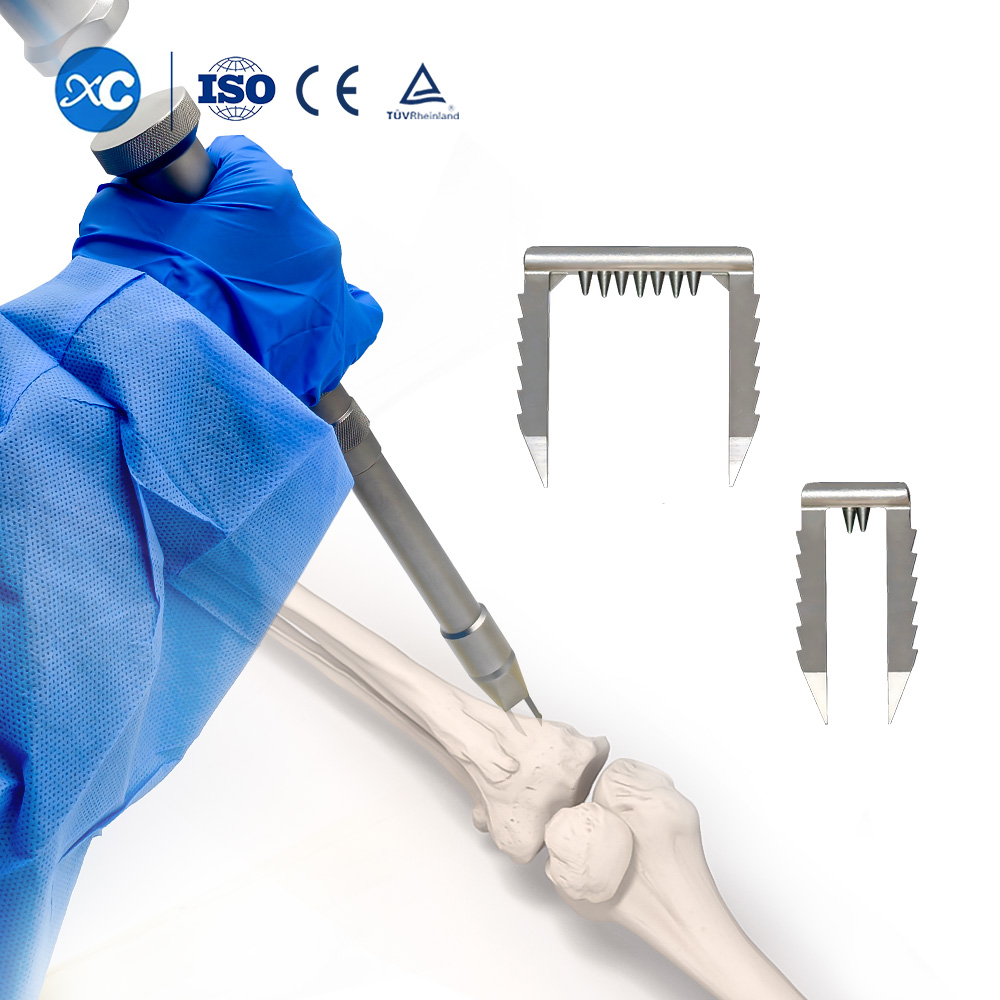 Ligament Staple | Soft Tissue Fixation for ACL Reconstruction | XC Medico Sports Medicine