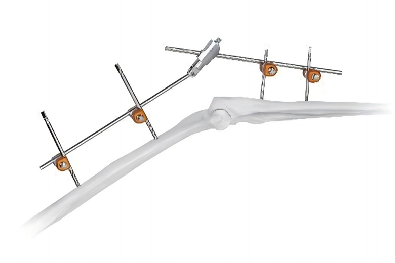 Combinational & Modular External Fixation System