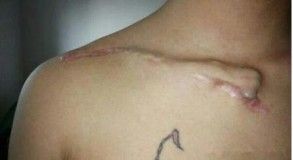 Dijanjosi u Trattament ta 'Frattura ta' Clavicle-30