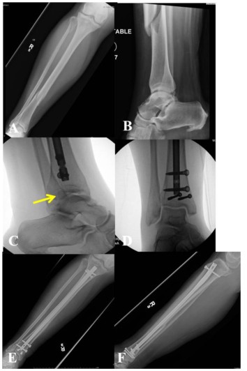 បច្ចេកទេសជួសជុលក្រចក Tibial Tibial Tireationulluralary-1