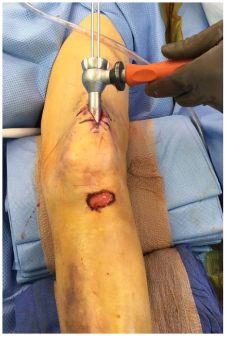បច្ចេកទេសជួសជុលក្រចក Tibial Tibial Tripationullalary-4