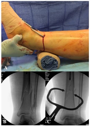 បច្ចេកទេសជួសជុលក្រចក Tibial Tibial intripullary-6